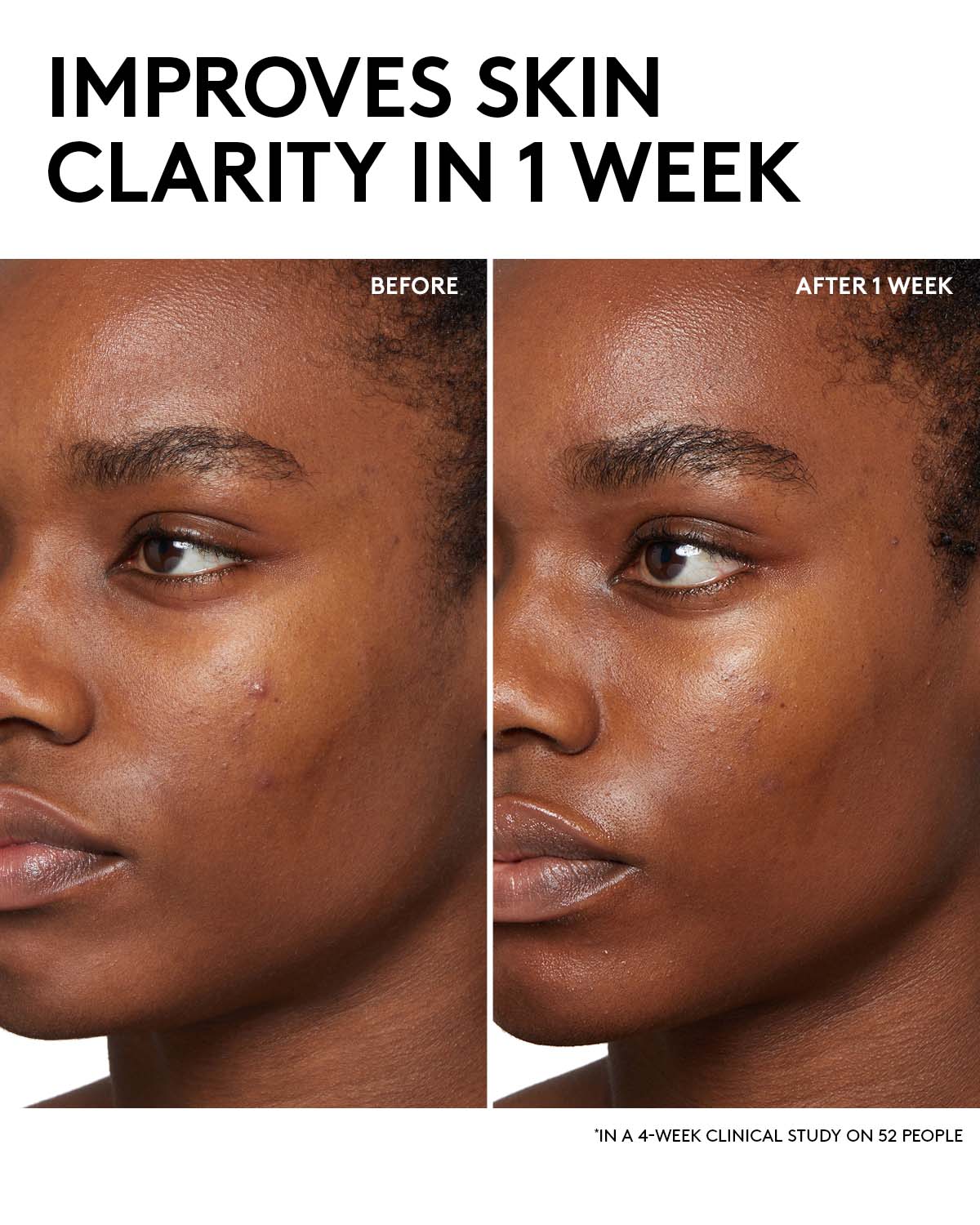 Improves skin clarity in 1 week in a 4-week clinical study on 52 people. Before and After image of model that used Cherry Dub BHA Toner with Salicylic Acid + Aloe Juice.