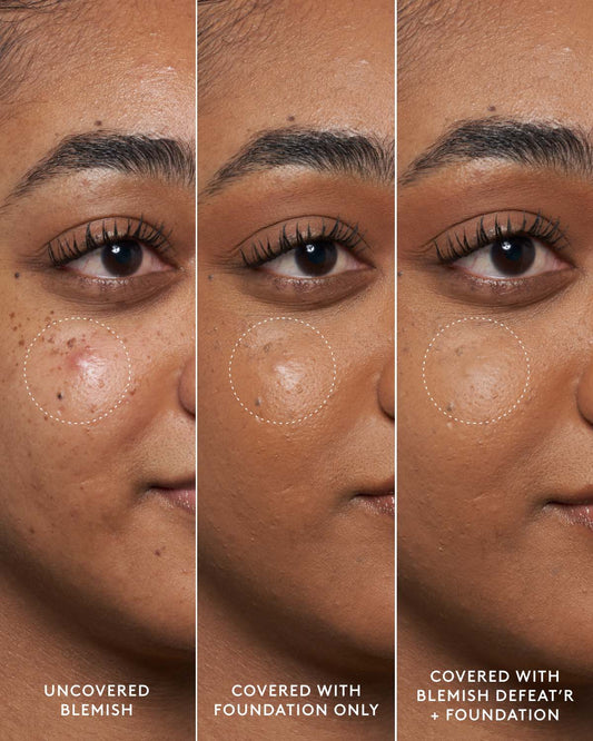Close-up of model's medium-toned face showing an uncovered blemish, a foundation-covered blemish and a foundation and Blemish Defeat'r BHA Spot-Targeting Gel-covered blemish.