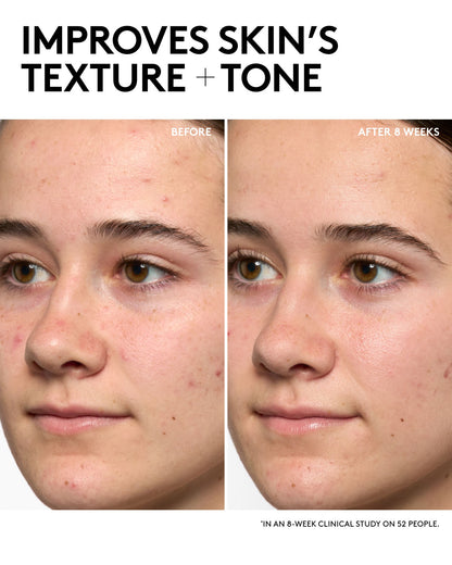 Before and after comparison of a person's face with text indicating improvement in skin texture and tone.